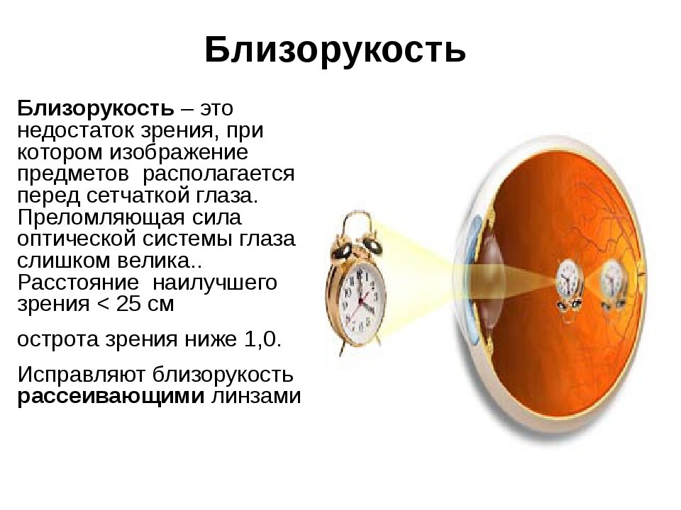 Презентация про близорукость