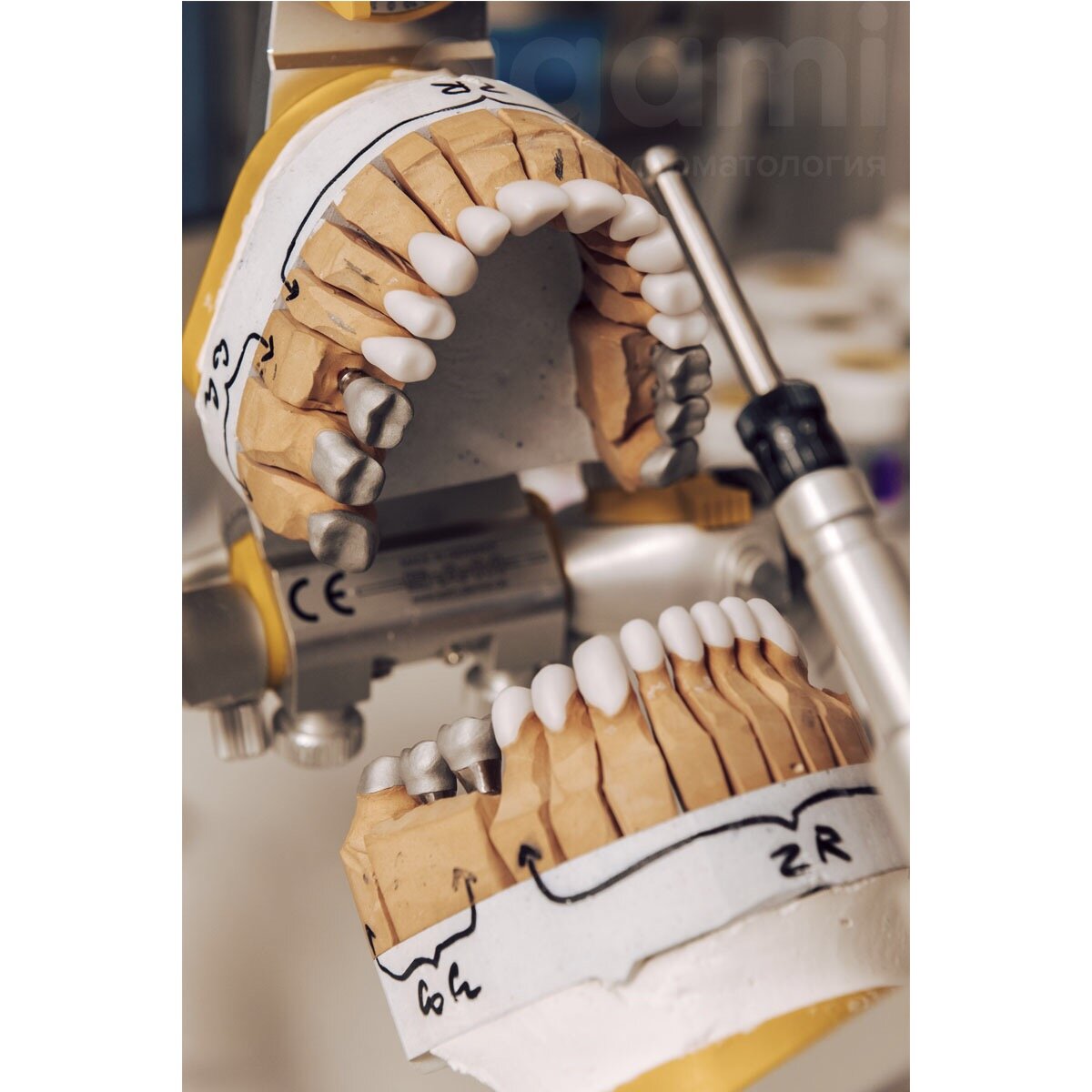 Комбинированная, тотальная работа на металлокерамике и цирконе 