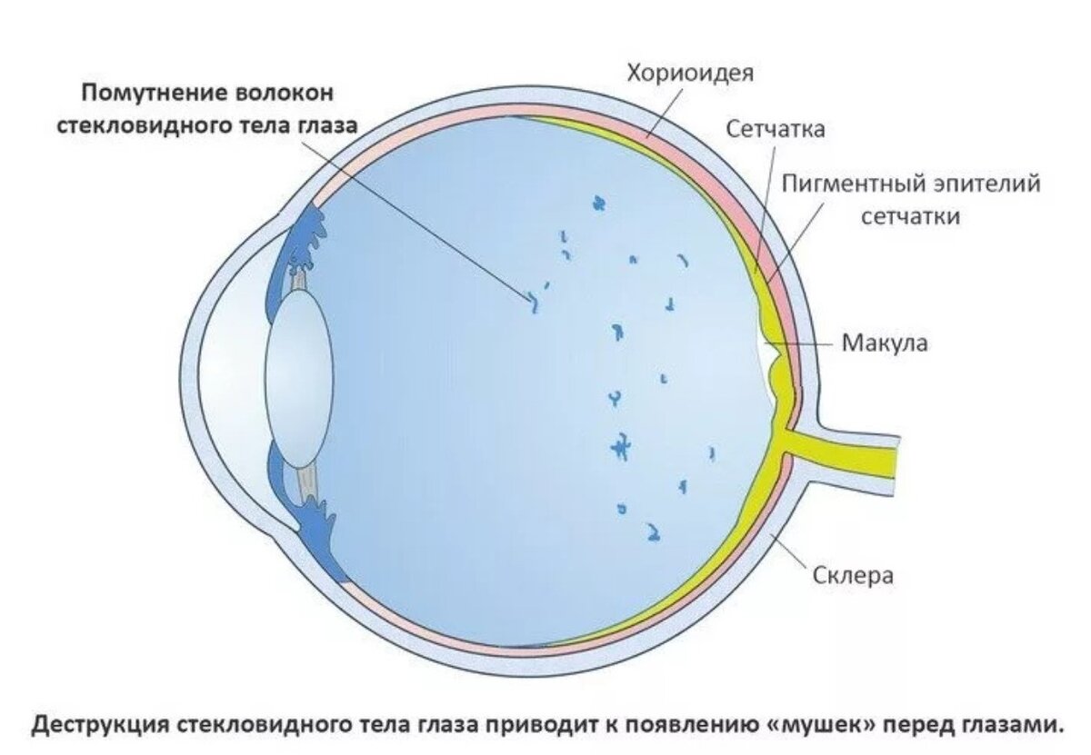 Деструкция стекловидного тела капли. Деструкция стекловидного тела глаза. Диструктив стеклоаидного тела глаза. Де трукция стекловидного тела. Деструкция световмдного тела.