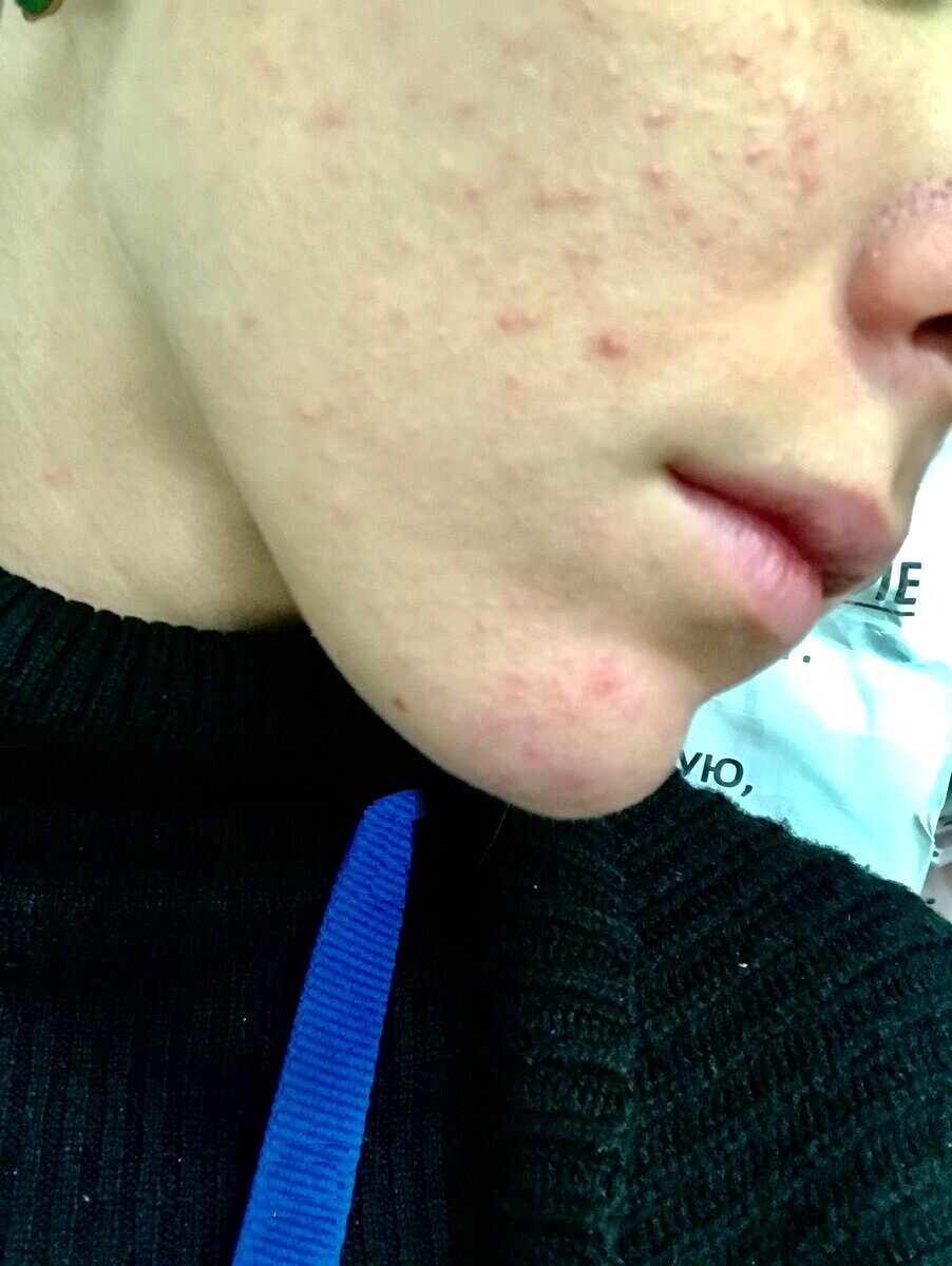 Моя кожа до правильного ухода