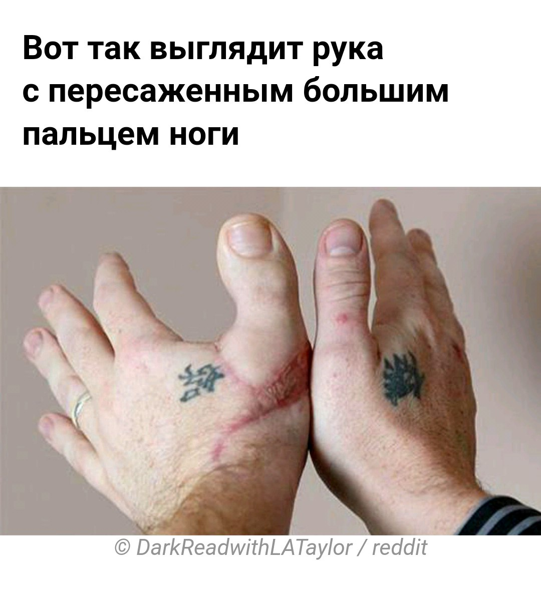 На руку пересадили большой палец ноги. Источник фото https://vk.com/xirologia