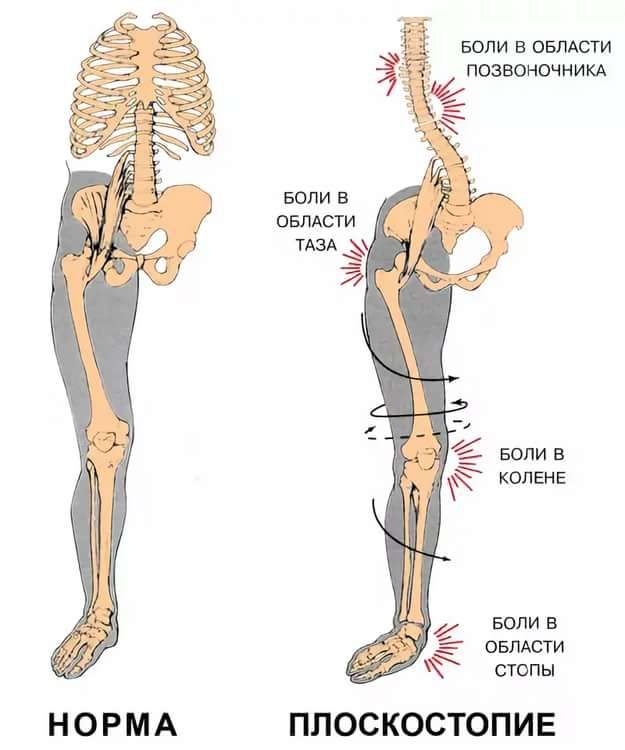 Боли в ноге от бедра до ступни. Влияние плоскостопия на коленные суставы. Косолапие и плоскостопие. Стопа и позвоночник. Осложнения плоскостопия.