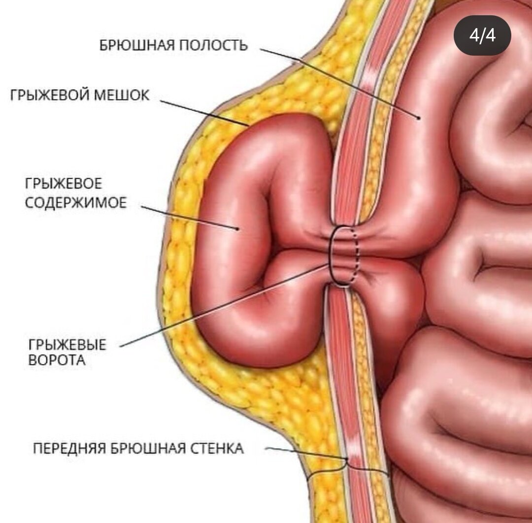 Грыжа симптомы. Ущемленная вентральная грыжа. Вентральная грыжа живота. Грыжа передней брюшной стенки. Пупочная грыжа передней брюшной стенки.