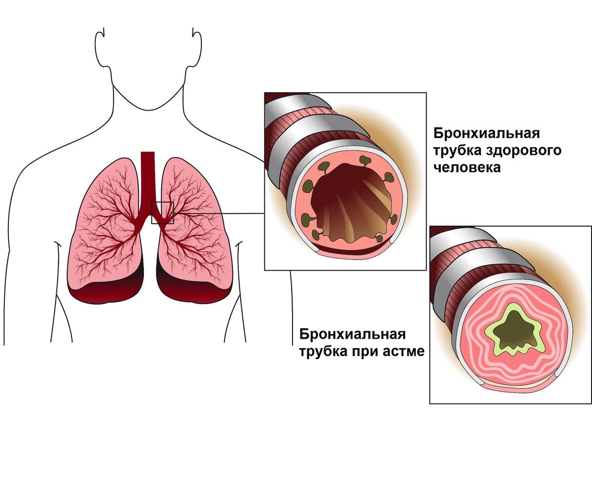 Бронхиальная астма