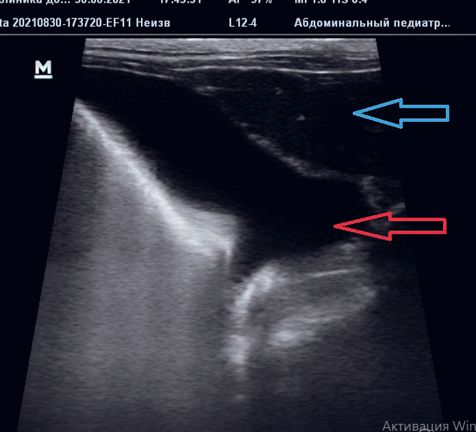 Рис. 1. Гидроторакс. Красная стрелка-свободная жидкость; Синяя стрелка-печень