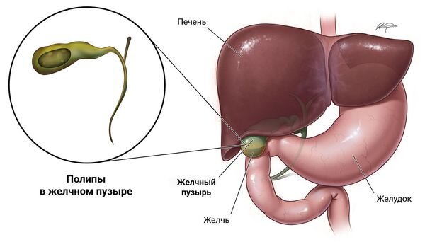 Удаление полипов желчного пузыря