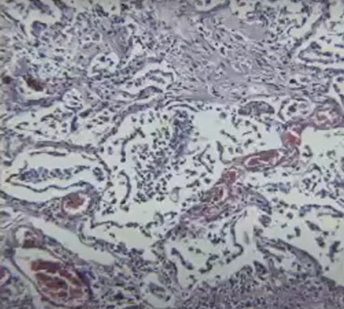 Фото из презентации д.м.н. Марии Викторовны САМСОНОВОЙ. Патологическая анатомия легких при COVID-19.  На фото поражение и десквамация эпителия альвеол. Ссылка: https://youtu.be/BOEMn8Hgdio 