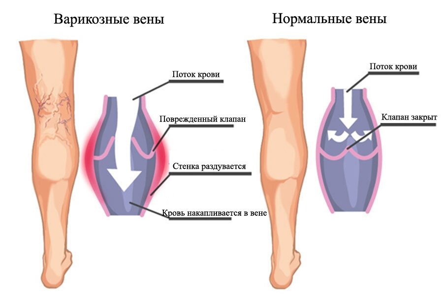 Варикозное расширение вен и тренировки. Как разные виды нагрузок влияют на заболевание. Полезные и вредные нагрузки при…