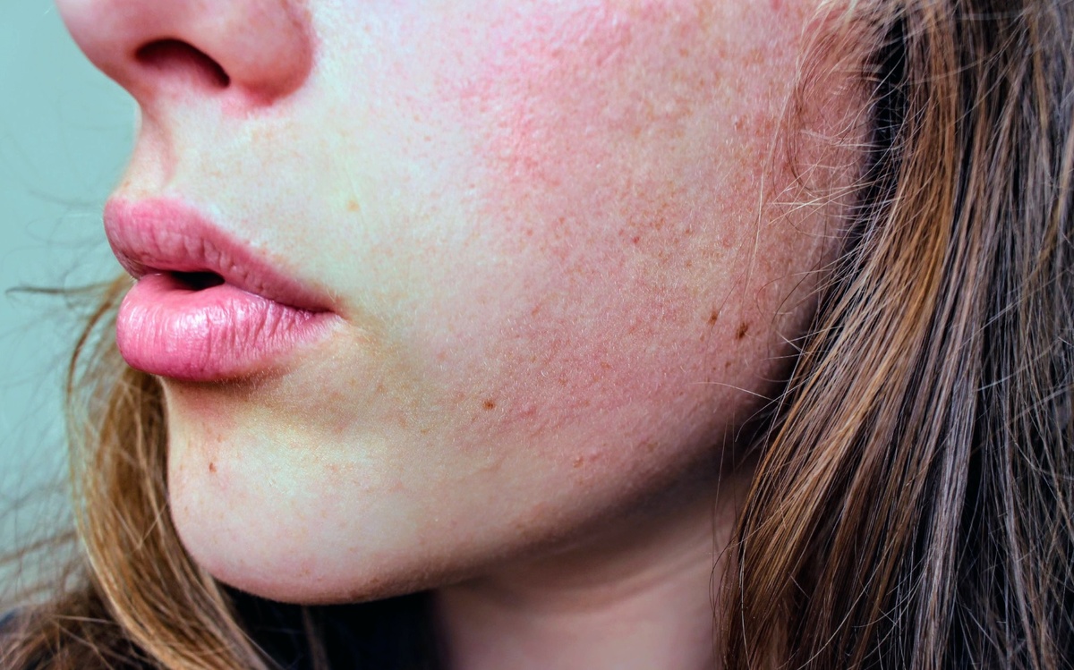 Фото дерматита на лице