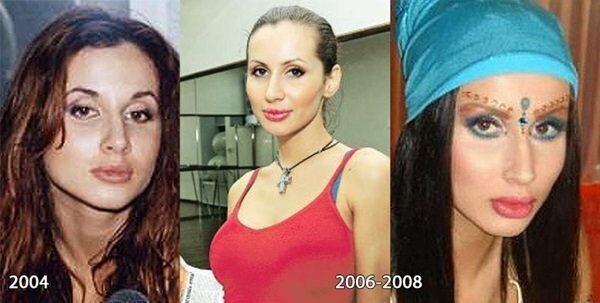 Светлана до и после пластики