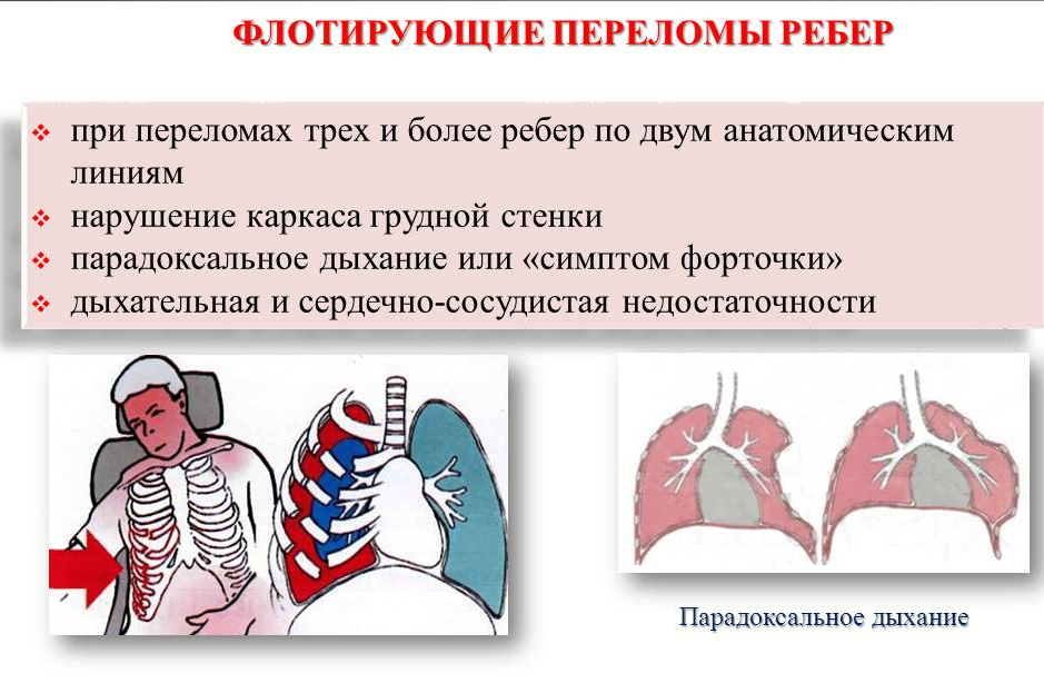 Множественные переломы ребер карта вызова