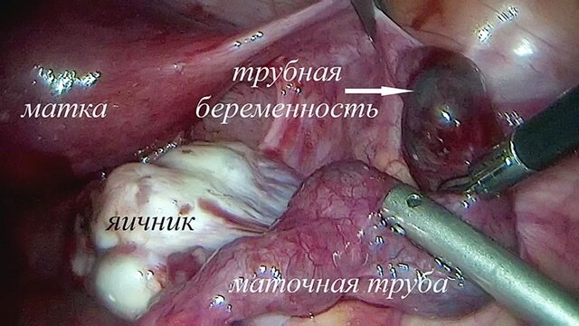 Беременность с одной маточной трубой | Клиника «Центр ЭКО-Партус»