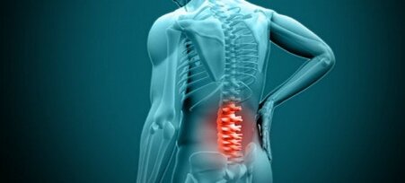 Радикулит - симптомокомплекс, при котором наблюдается клиника поражения корешков спинного мозга