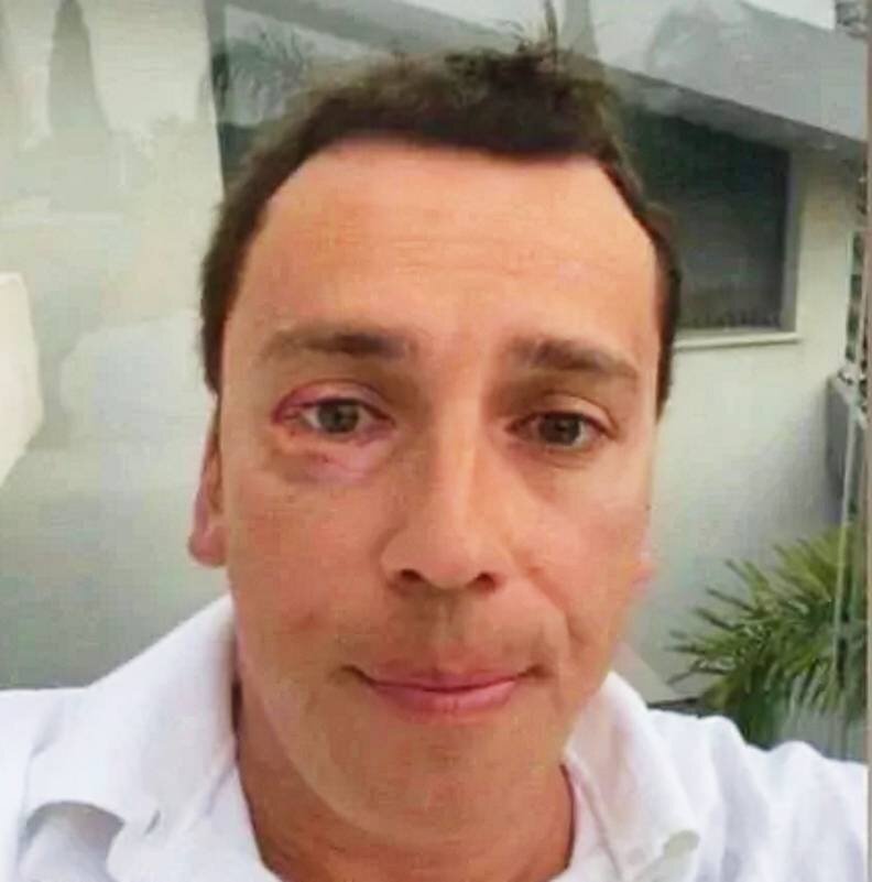    Фото Максима Галкина с подбитым глазом распространяется в соцсетяхСоцсети