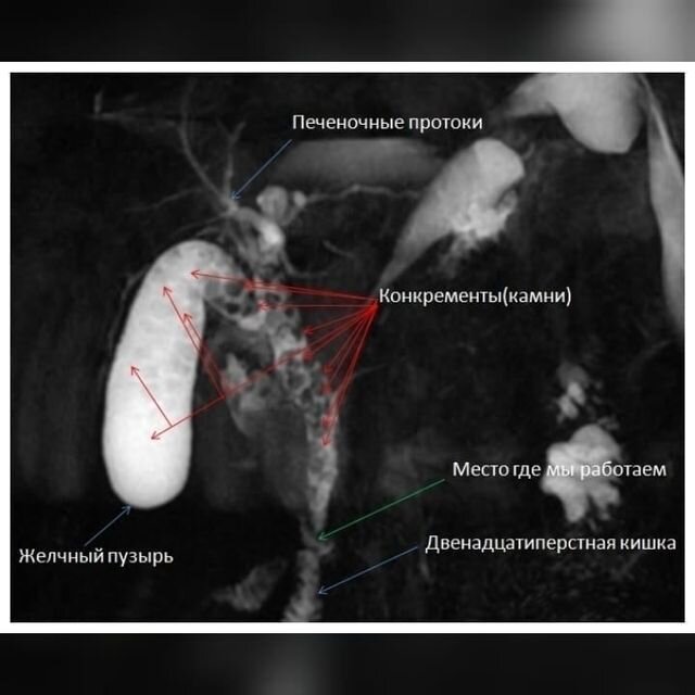Заболевания желчных и печеночных протоков