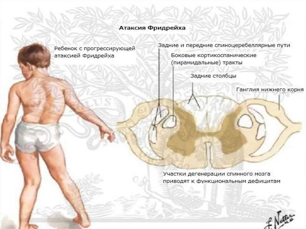 Болезнь фридрейха картинки