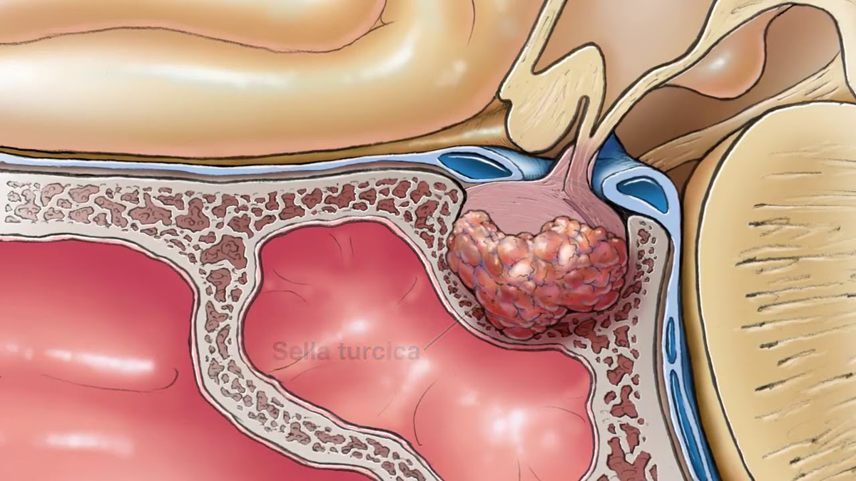 Транссфеноидальная аденомэктомия гипофиза. Опухоль аденома гипофиза. Аденома гипофиза патанатомия.