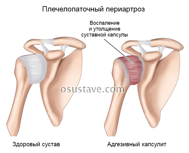 Плечелопаточный периартрит анатомия