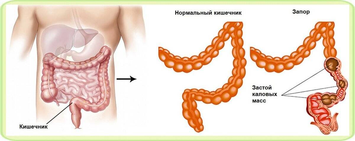 Схема запора