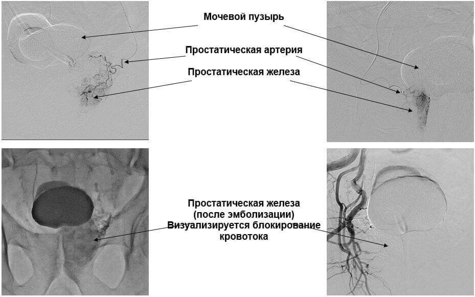 Эмболизация простатических артерий