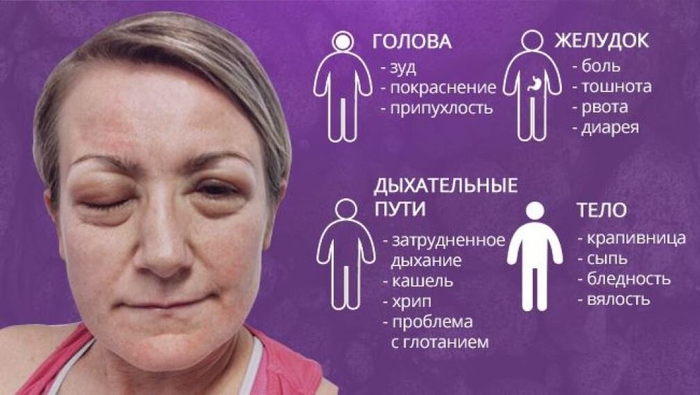 Описание типичных клинических проявлений анафилактического шока. Источник: trendmedika.ru