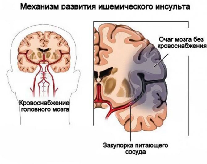 Лечение хронической ишемии мозга в Житомире
