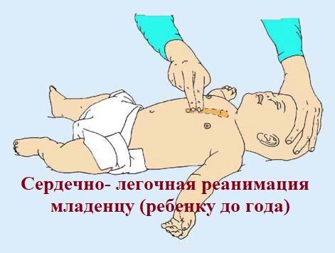 Массаж сердца при выполнении сердечно-легочной реанимации