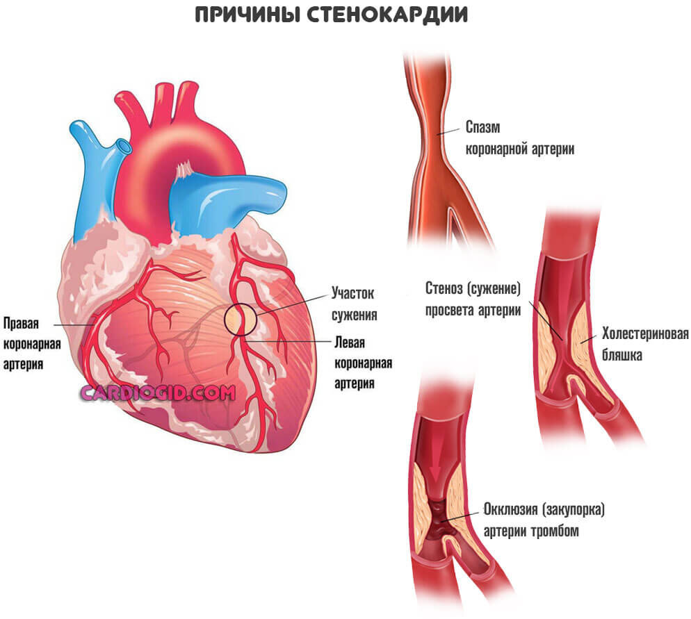 Причины инфаркта