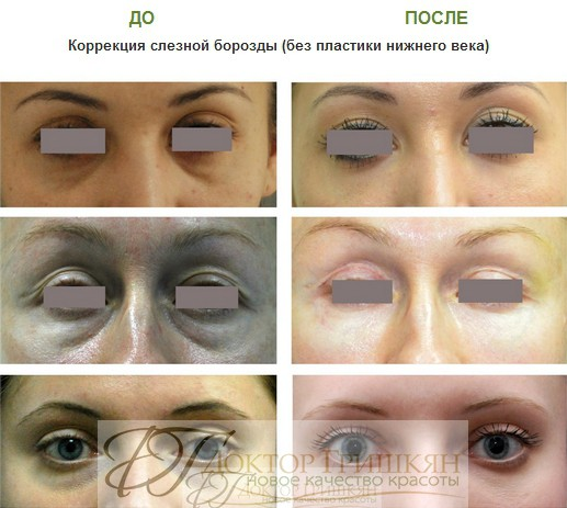 Фото до и после липофилинга слезной борозды. Фото взято с сайта Д.Р. Гришкяна. Имеются противопоказания, требуется консультация специалиста.