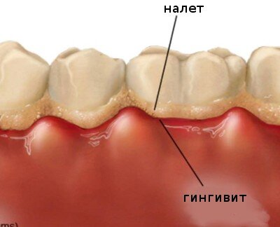 Воспаление десен у беременных