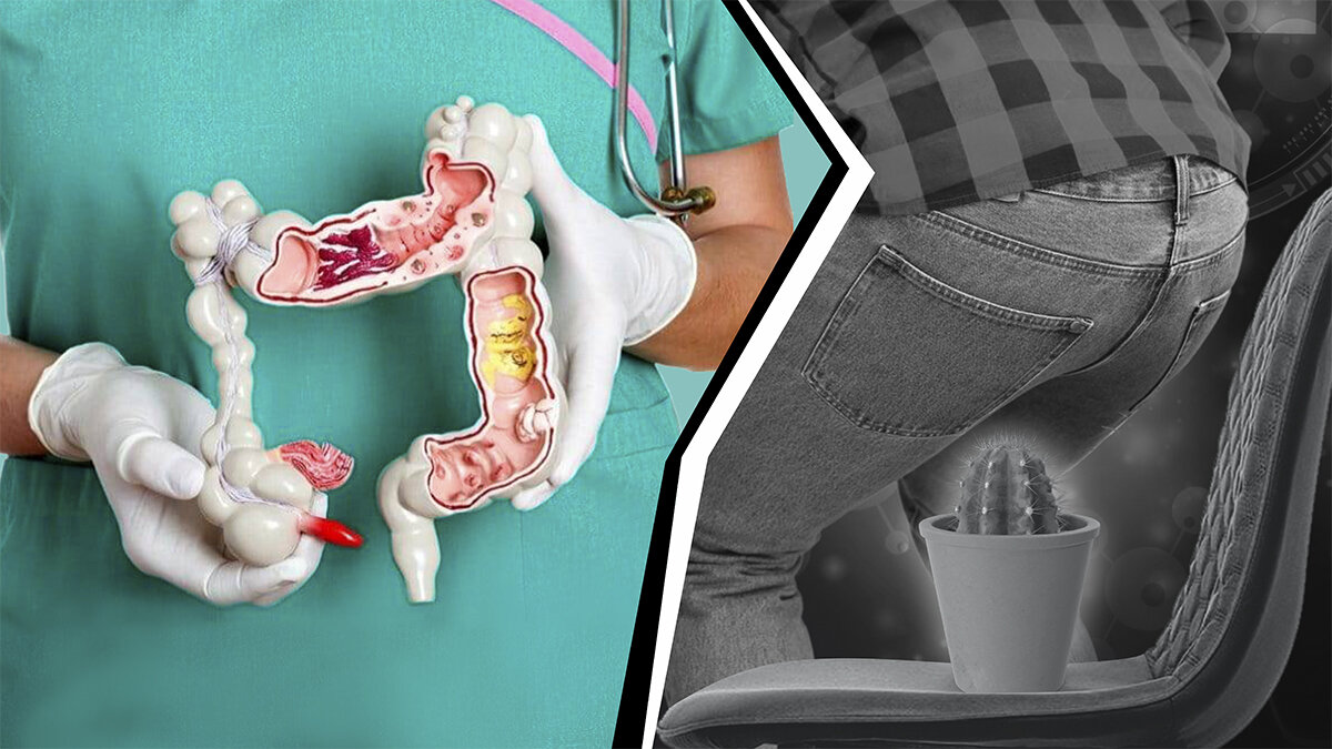"Деликатная" тема. Как облегчить боль при геморрое