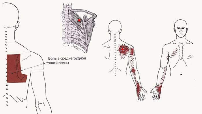 Триггерные точки на спине схема