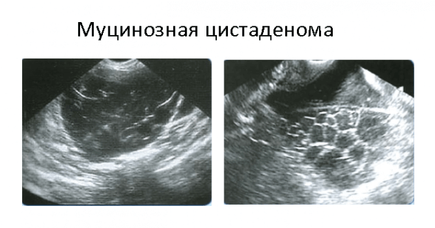 Муцинозная цистаденома яичника на узи фото