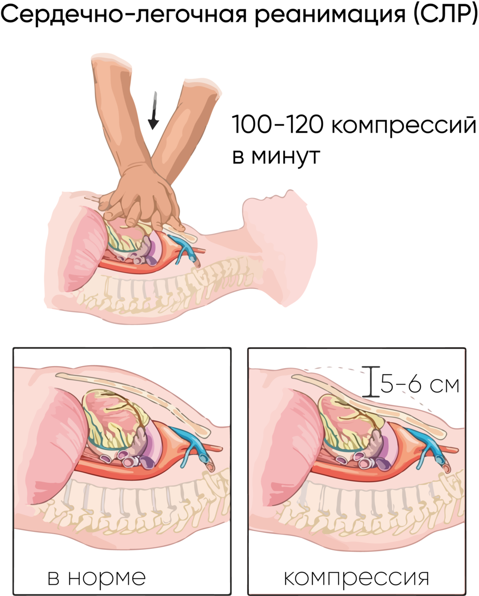 Сердечно-легочная реанимация (СЛР) | Кардиохирург Нургалиев Рахим Ринатович  | Дзен