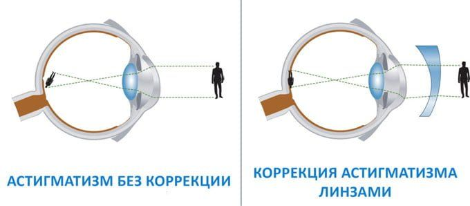 При астигматизме используются специальные линзы, у которых в одном меридиане одна оптическая сила, в противоположном - другая.