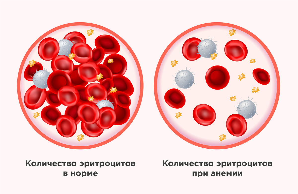 Железодефицитная анемия гемоглобин. Эритроциты при анемии. Анемия картинки. Эритроциты в норме и с анемией.