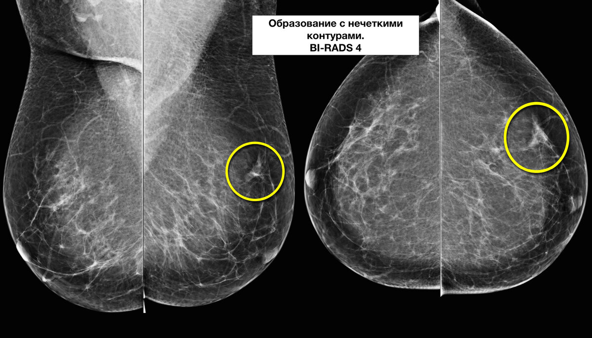 В правой молочной