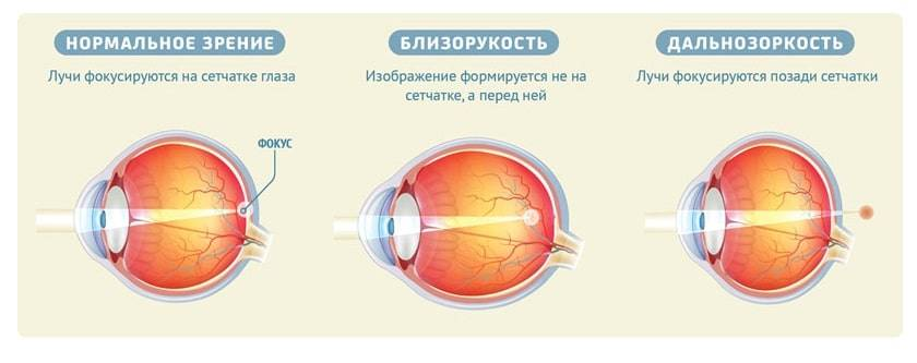 Близорукость первая помощь. Миопия схема глаза. Нормальное зрение близорукость дальнозоркость схема. Что такое близорукость (миопия) и дальнозоркость (гиперметропия). Форма глаза при близорукости и дальнозоркости.