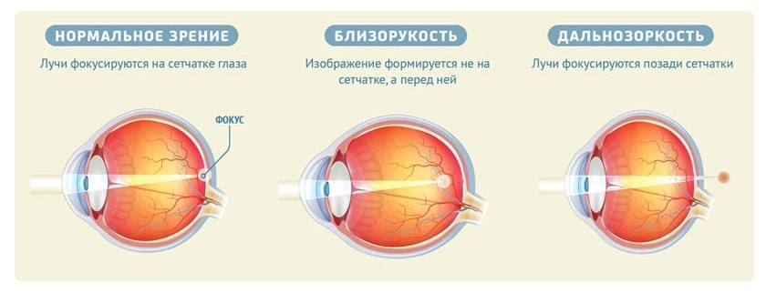 Лучи зрения. Миопия схема глаза. Нормальное зрение близорукость дальнозоркость схема. Норма близорукость дальнозоркость. Нарушение зрения схема близорукость и дальнозоркость.