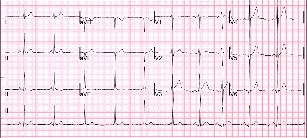 ЭКГ пациента, записанная при обращении 