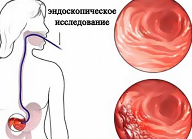 Хронический гастрит: причины, симптомы, лечение и диета при обострении | Клиника «СОВА» Воронеж