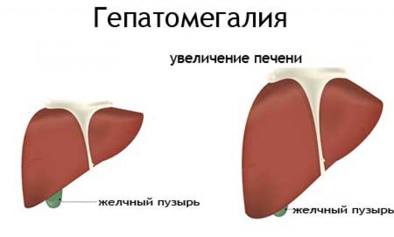 Причины увеличения печени: основные факторы и методы лечения