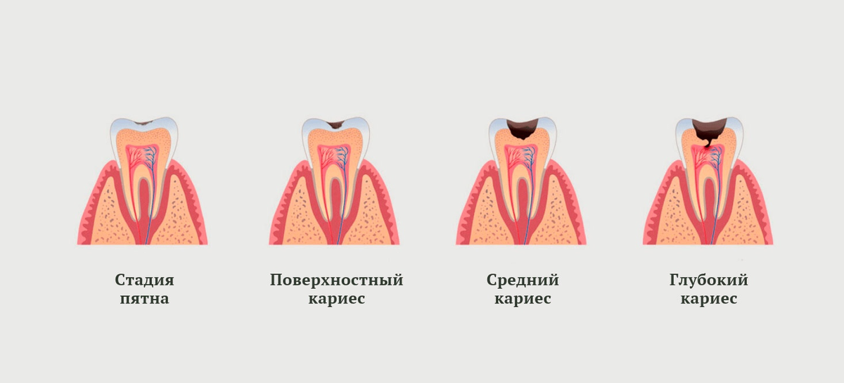 Стадии развития кариеса