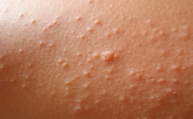  Сухость кожи на бедрах и ягодицах.Пожалуй, это самая распространенная проблема, из-за которой сыпь покрывает кожный покров