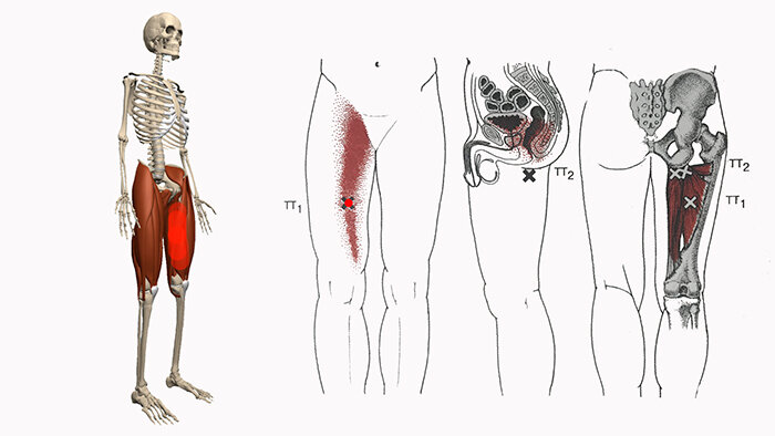 Почему боли бедро. Триггерные точки портняжная мышца. Триггерные точки прямой мышцы бедра. Портняжная мышца тазобедренного сустава. Приводящие мышцы бедра триггерные точки.