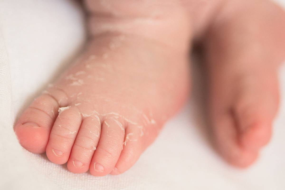 Шелушится кожа у новорожденного ребенка: причины, чем увлажнять сухую кожу