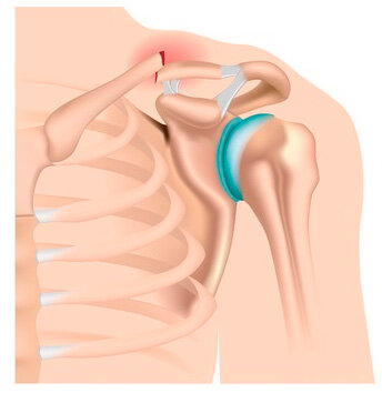  Перелом ключицы со смещением костных отломков