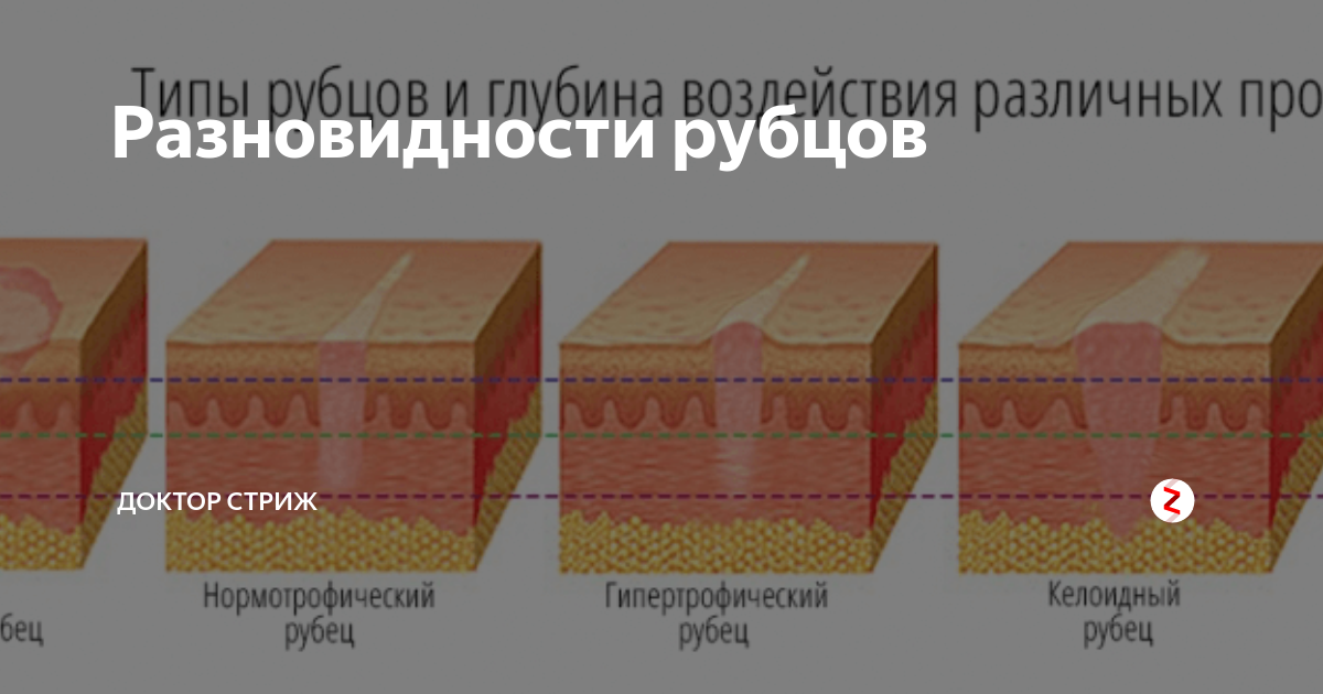 Лазерная шлифовка ягодиц в Москве - цена в клинике Ланцетъ