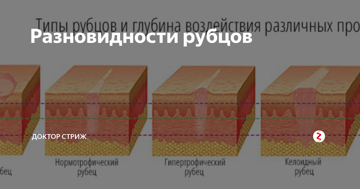 Рубцовых изменений