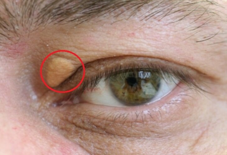 как убрать жировик с глаза
